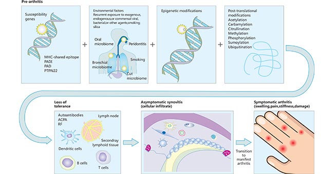 類(lèi)風(fēng)濕性關(guān)節(jié)炎的發(fā)病途徑