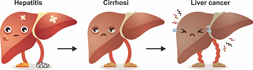 肝細胞損傷的研究進展